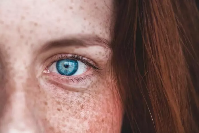 आपल्याला अतिरिक्त freckles एक एक्सस्टर आवश्यक आहे?