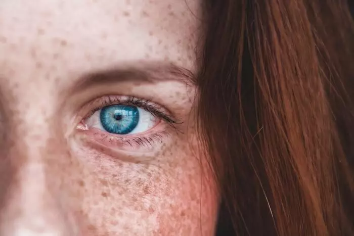 Əlavə freckles oxunu ehtiyacınız varmı?