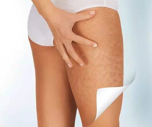 Die ganze Wahrheit über Cellulite