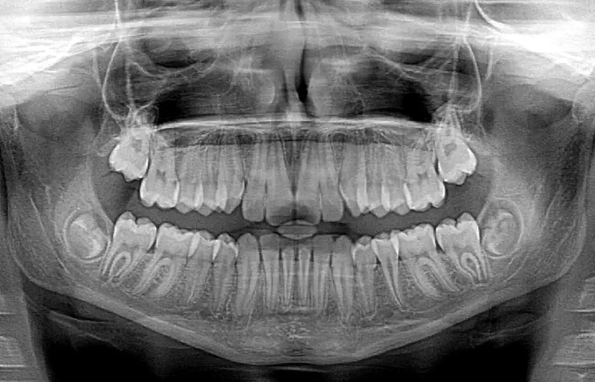 دندان های عقل تنها در نیمی از جمعیت رشد می کنند