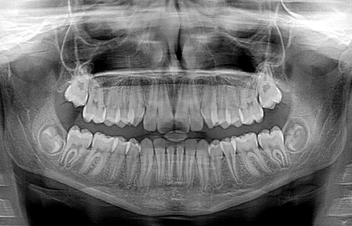 Les dents de saviesa només creixen a la meitat de la població